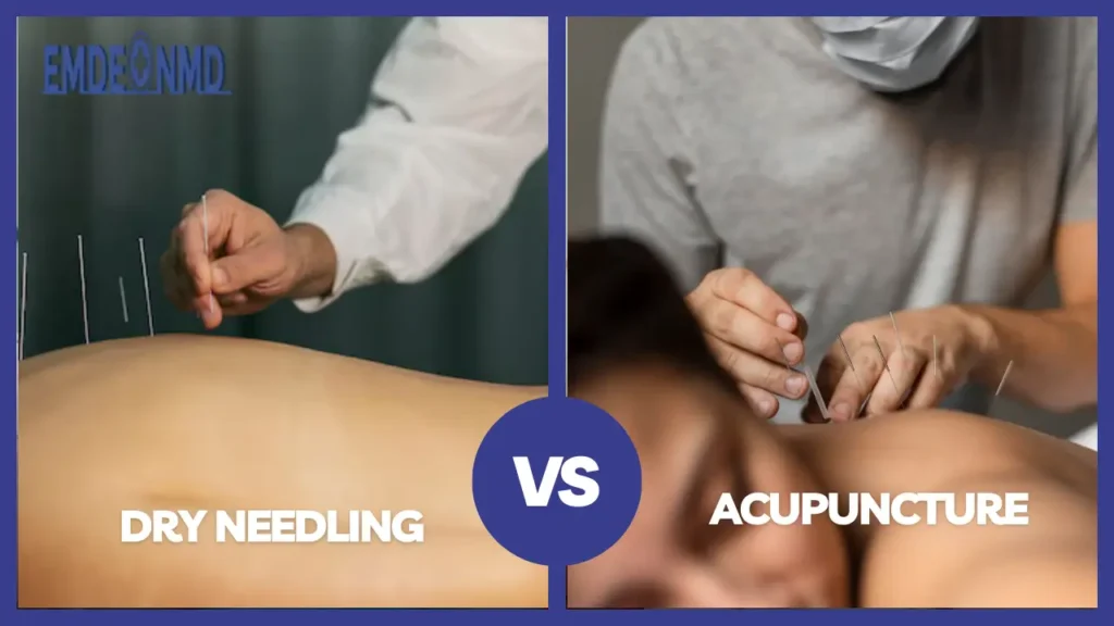 Dry Needling vs. Acupuncture